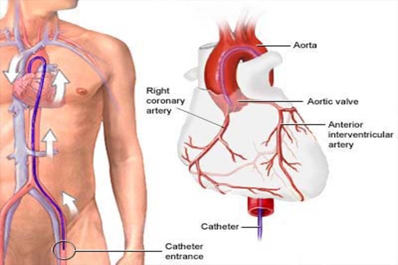 ANGIOGRAPHY