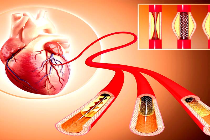 ANGIOPLASTY