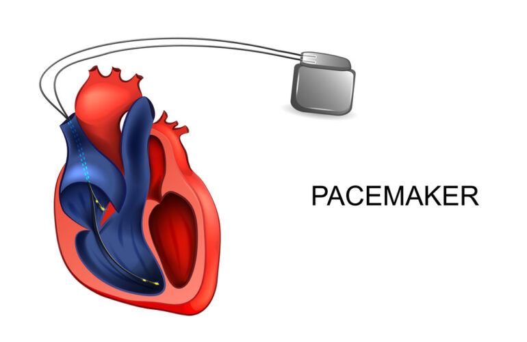 Pacemaker (For The Heart) - Pacemaker Doctors in Faridabad