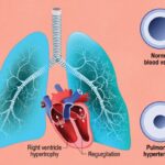 Pulmonary Heart Disease or Pulmonary Hypertension