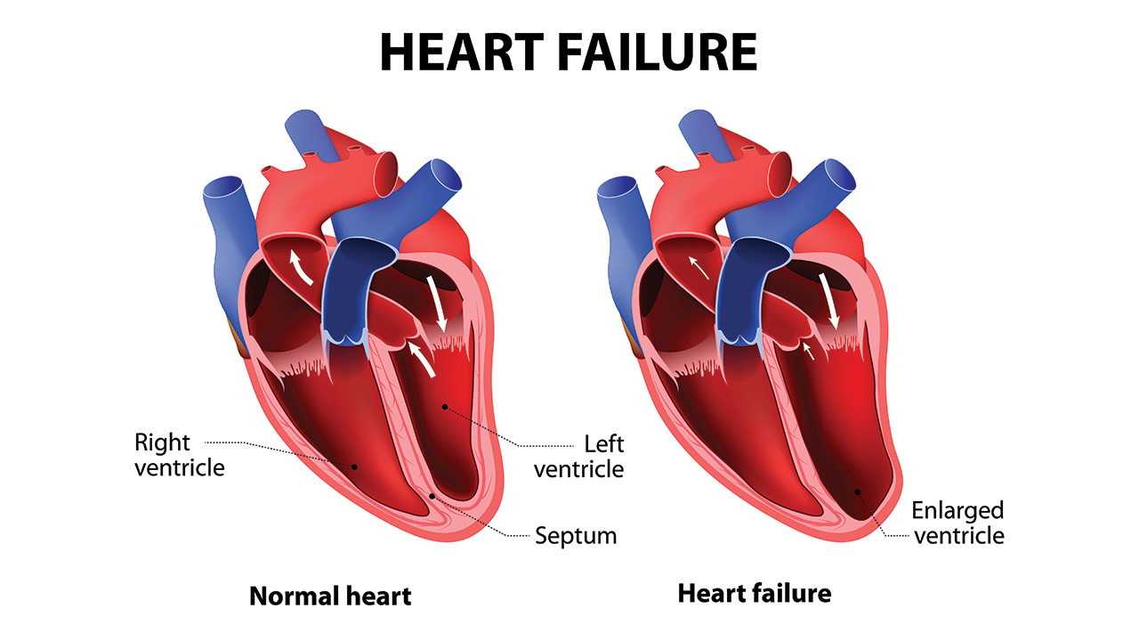 Best Cardiologist in Faridabad - Dr. Sanjay Kumar - Heart Failure Symptoms