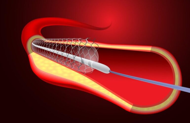 What is Angioplasty and Why You Need It - Dr Sanjay Kumar