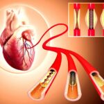 angioplasty