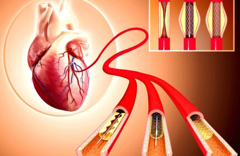 angioplasty