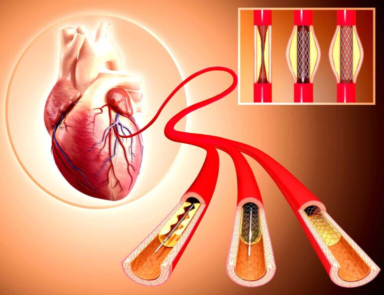 angioplasty