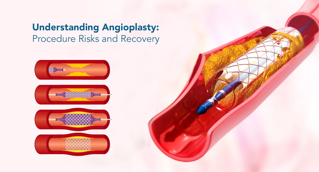 Understanding-Angioplasty-Procedure-Risks-and-Recovery