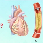 What Is Angiography