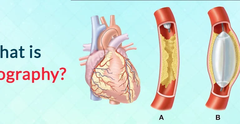 What Is Angiography
